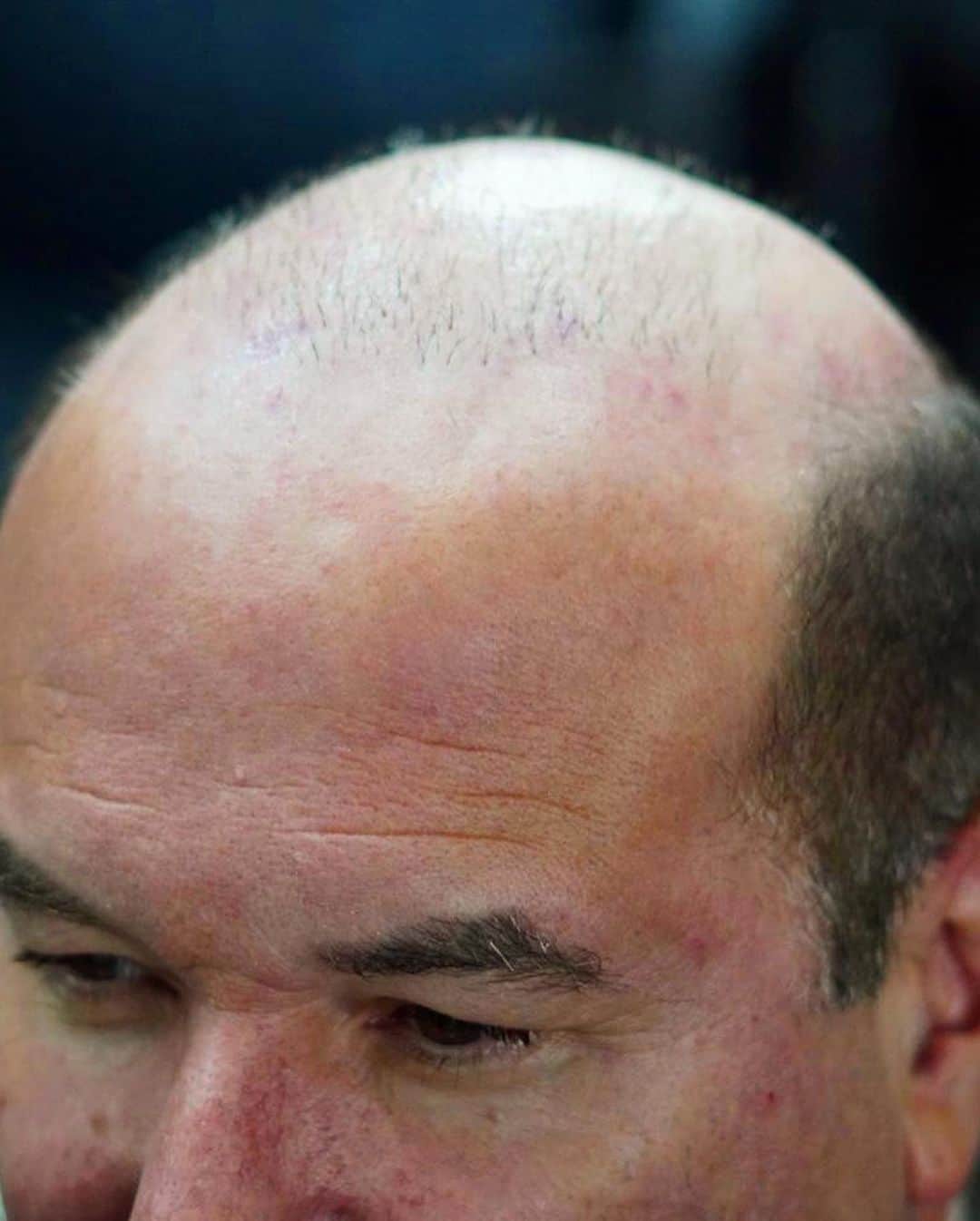 Hair Plugs Vs. Hair Transplant: Which Is Best For Me? - Tattooed Martha Hair Plugs Vs. Hair Transplant: Which Is Best For Me? - Tattooed Martha