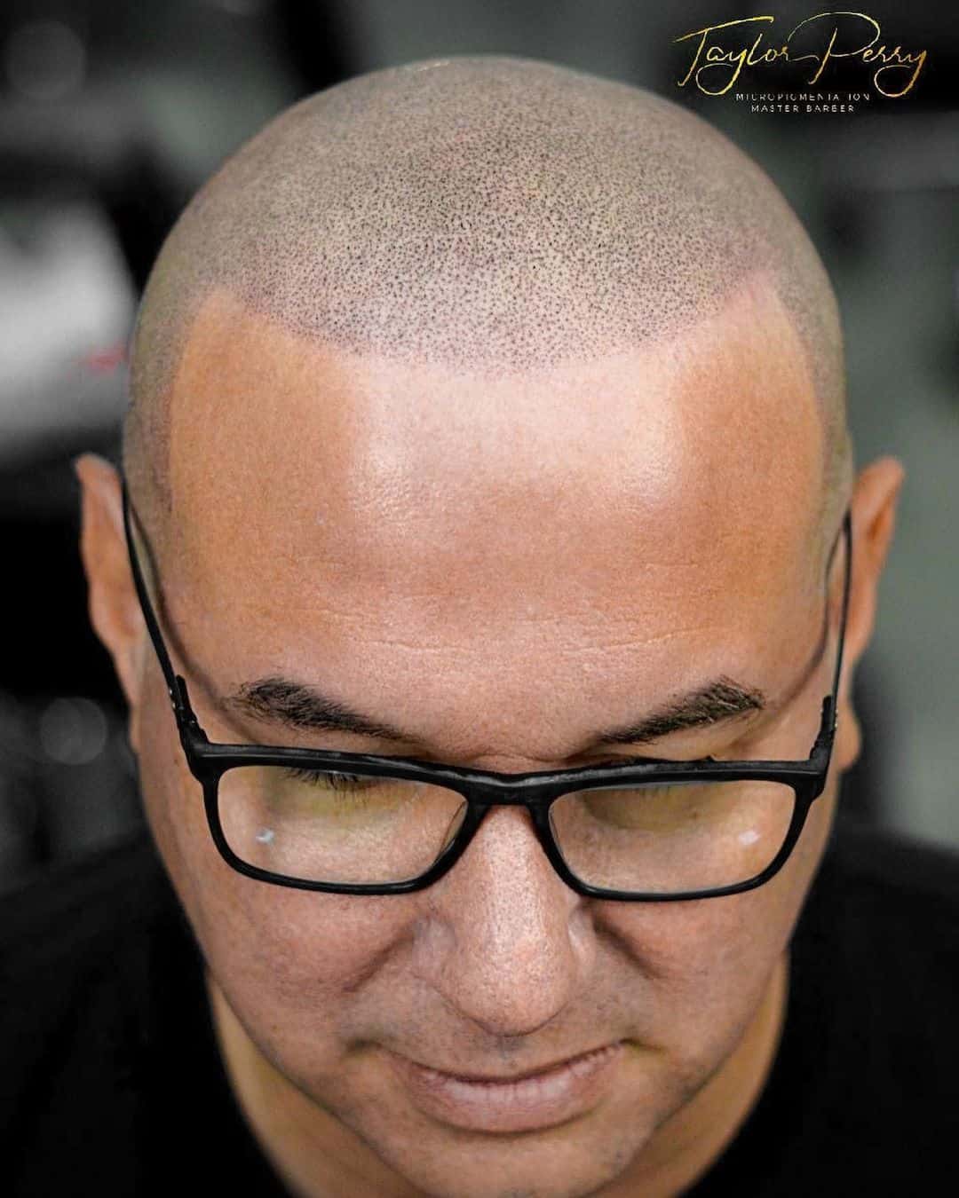 Hair Plugs Vs. Hair Transplant: Which Is Best For Me? - Tattooed Martha Hair Plugs Vs. Hair Transplant: Which Is Best For Me? - Tattooed Martha