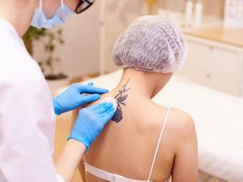 Laser tattoo removal in a cosmetology clinic.