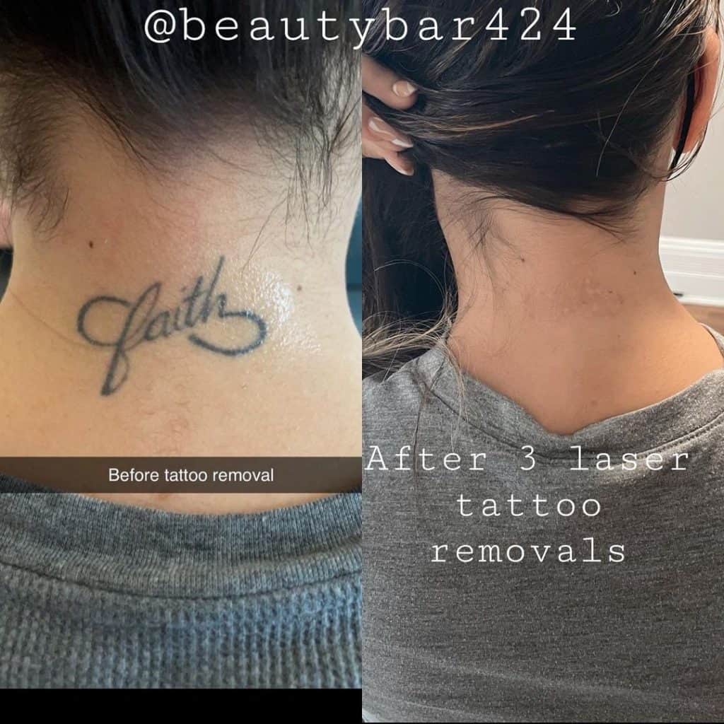 Does Tattoo Removal Leave Scars On Hands?