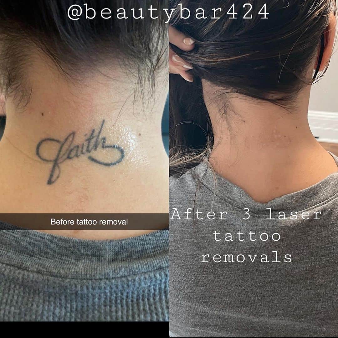 Laser Tattoo Removal doesn't leave scar