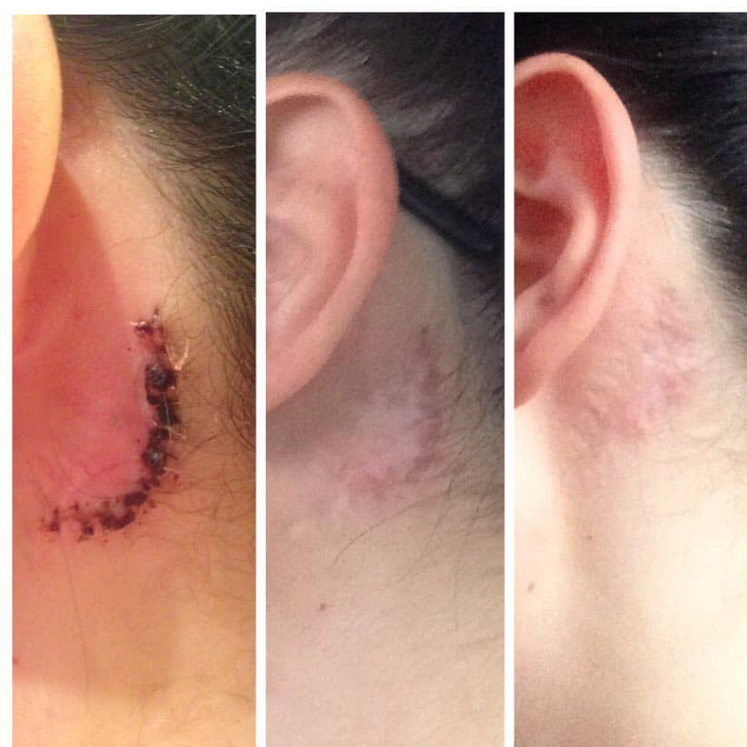 surgical tattoo removal will leave a scar
